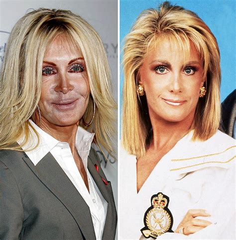 did joan van ark have plastic surgery